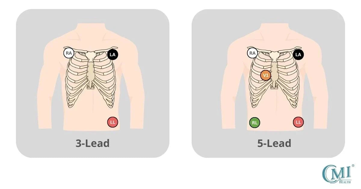 ECG Electrode Placement Guide: 3-Lead and 5-Lead Positioning